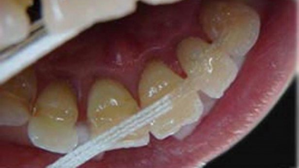 шинирование зубов при переломе челюсти